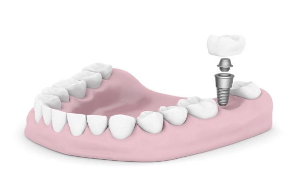 Things You Should Know About Dental Implants Posts